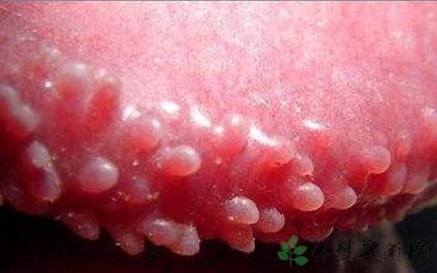 损害主要发生在龟头的边缘与冠状沟交界处和/或系带处.