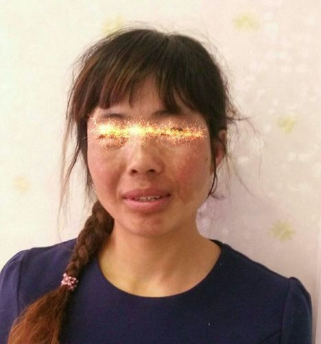 也称butterfly rash,是一种 a target="_blank" href="/item/红斑狼疮