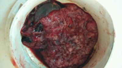 怀孕九周有胎心胎芽心管搏动没见血,孕酮低至7.