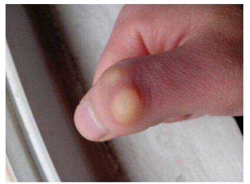 腱鞘囊肿 痛 肿 吓人!