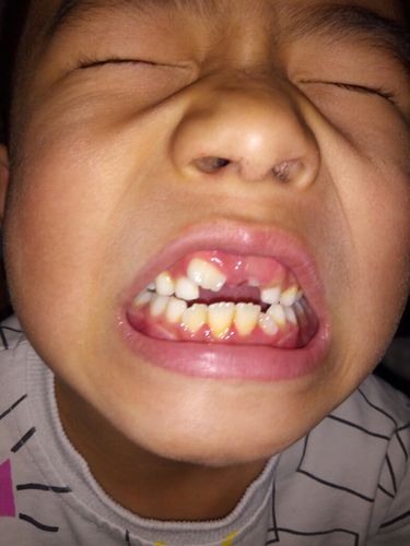 孩子换牙一颗门牙长歪了怎么办,能整回来吗,什么时候整?