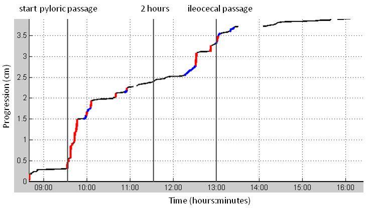 pyloric passage, 2 hour after pyloric passage, and ileocecal