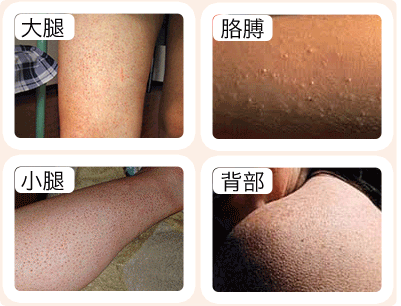 解决鸡皮肤还原平滑肌肤