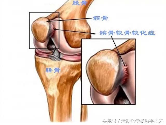 骨关节炎,髌骨软骨损伤依照什麼原则治疗?