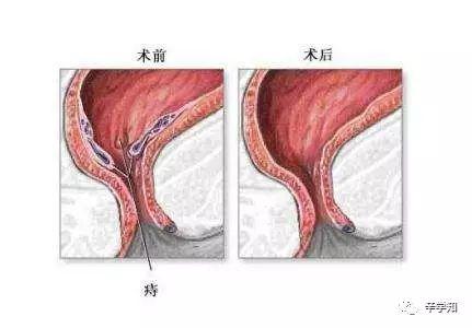 痔术后水肿的原因