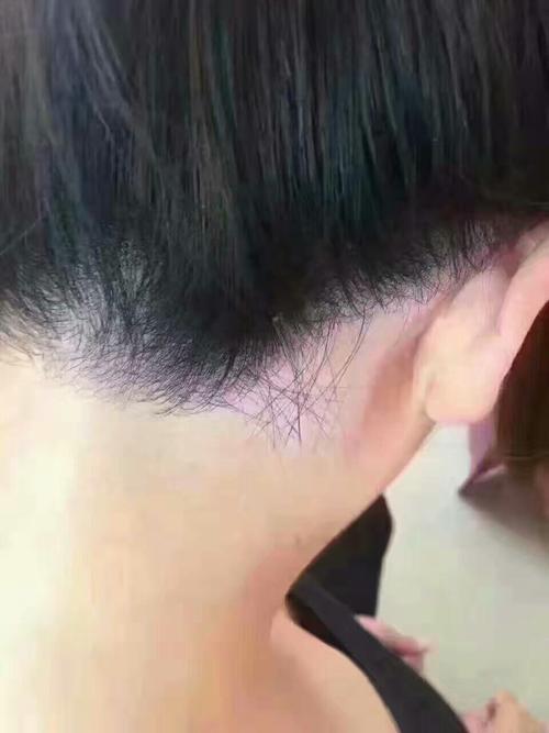 发际线前后对比