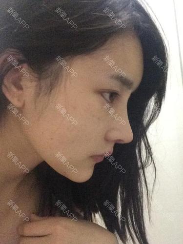 为什么鼻骨内推没有效果呢,正面看跟以前一样宽那,侧