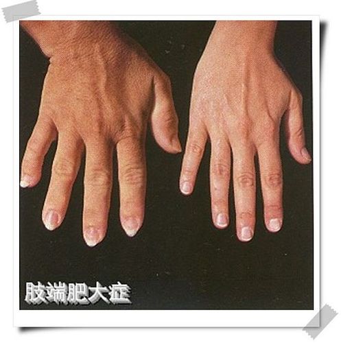 肢端肥大症——手部(图)