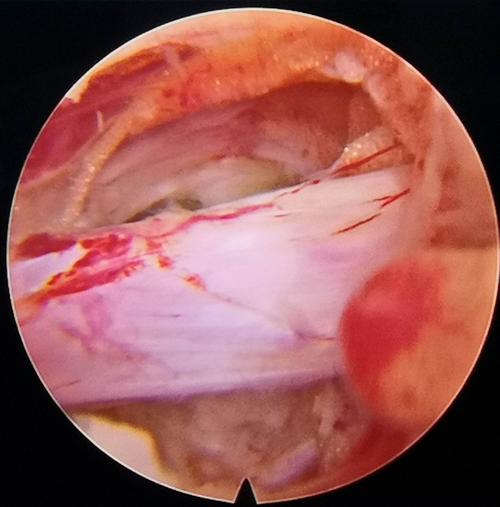 骨二科邓强主任团队杨镇源副主任医师完成甘肃省首例镜下纤维环缝合术