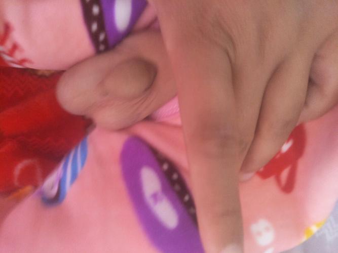 宝宝13个月鞘膜积液,能自己好吗,怎么办啊