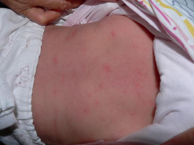 红斑病种 表现 宝贝刚出生时,皮肤表面的角质层还没有完全形成,真皮