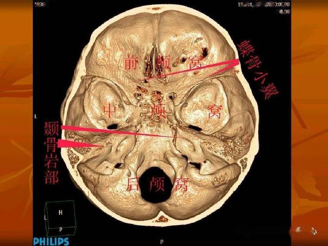 颅底ct高清图解 常见骨折部位图示