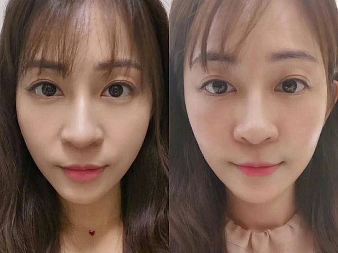 鼻基底填充改善法令纹