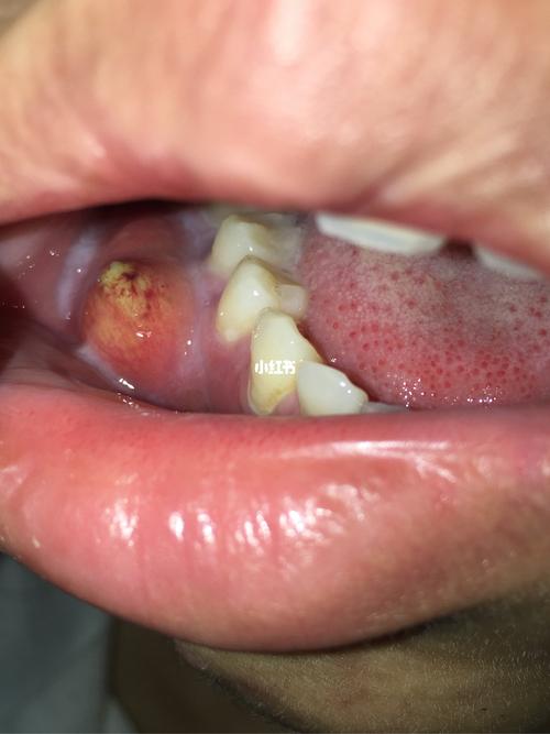 牙齿长脓包,这种是上火引起的吗?