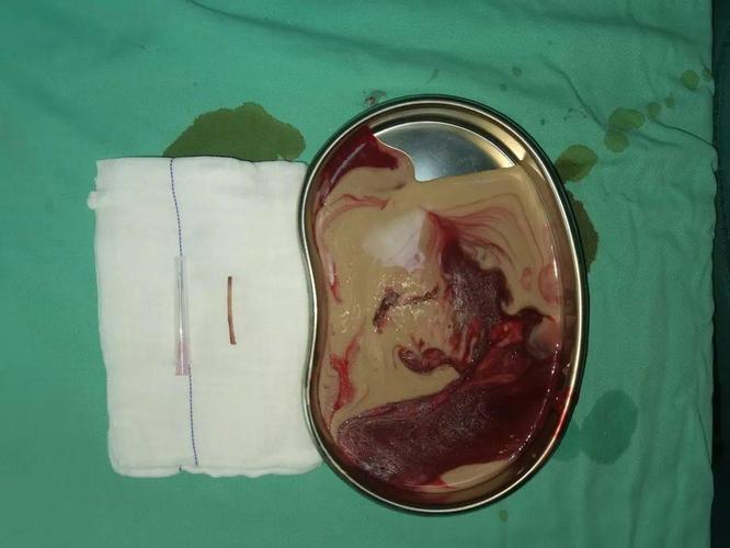 医学课堂|误吞了这个东西,最后让患者得了肛周脓肿!