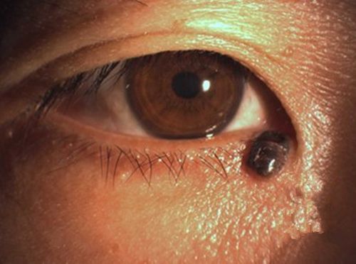 严重眼睑色素痣治疗康复图