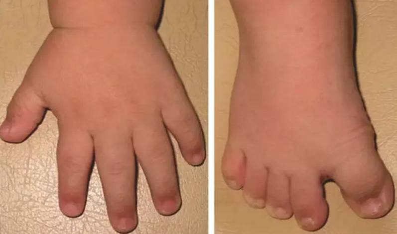 唐氏综合征有哪些特征?