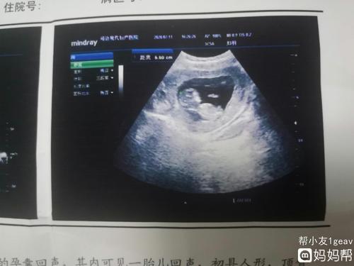 12周nt检查,有会看男孩女孩的宝妈吗?