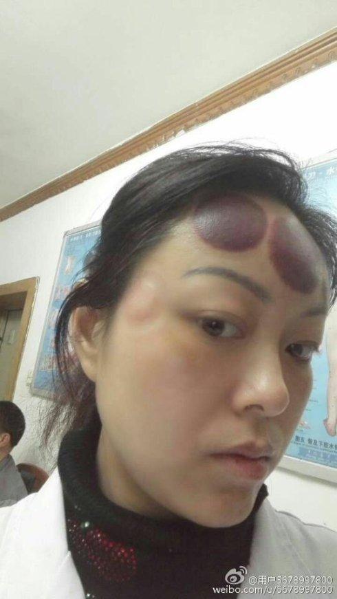 [转载]看图说话(一)——脑门拔罐