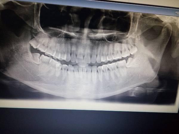 下颌阻生智齿,口腔医院拍了牙片,这种难度大不大?看网友好多需要缝