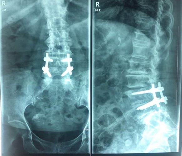 85岁的陈奶奶5年前,突然出现无明显诱因的腰部不适,大腿外侧和臀部
