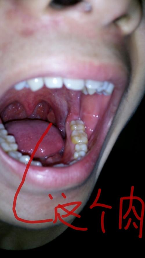 请问,喉咙舌根左右连耳朵的那个位置,有点深进去的地方,在一小块肉的.