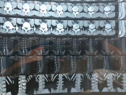 腰椎间盘突出手术经历