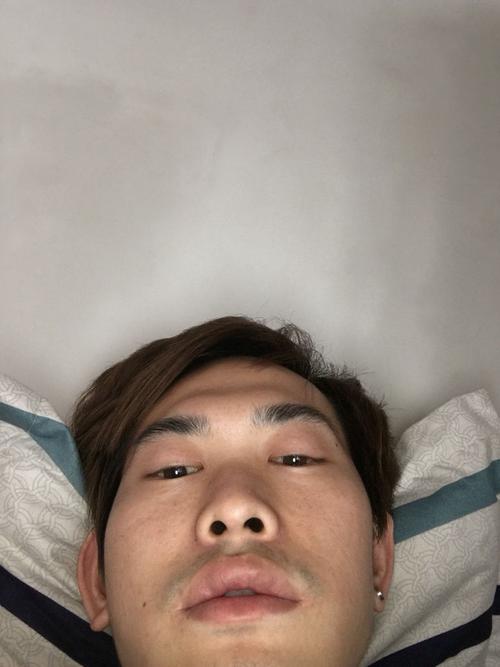 眉骨突出很高是什么原因造成的,而且太阳穴凹陷,很难看,好像去做手术