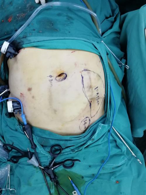 20180814复杂性切口疝