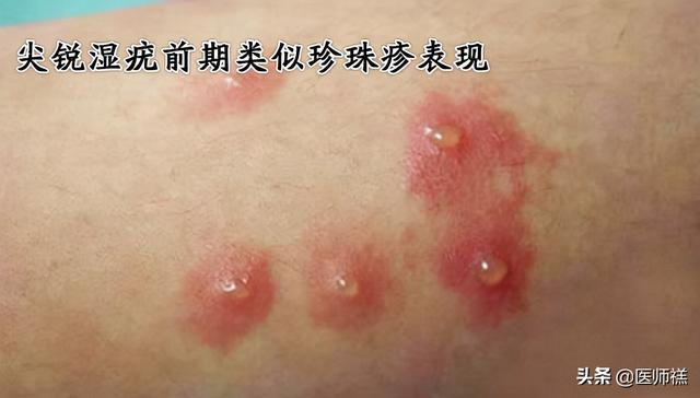 总结丘疹的形状较多不容易区分,但是在敏感部位出现的丘疹仍然具备