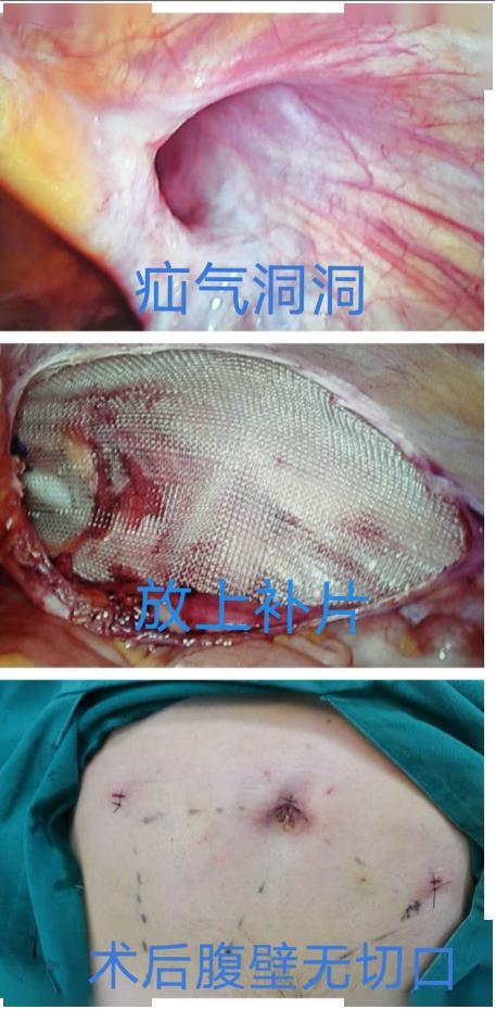 热血外科 | dr.liu聊科普之疝气