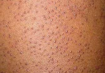 毛周角化症图片