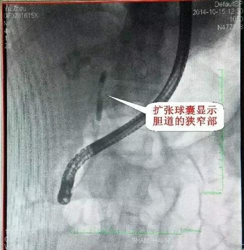 首选通过内镜下逆行胆胰管造影/引流术(ercp)进行吻合口球囊扩张和