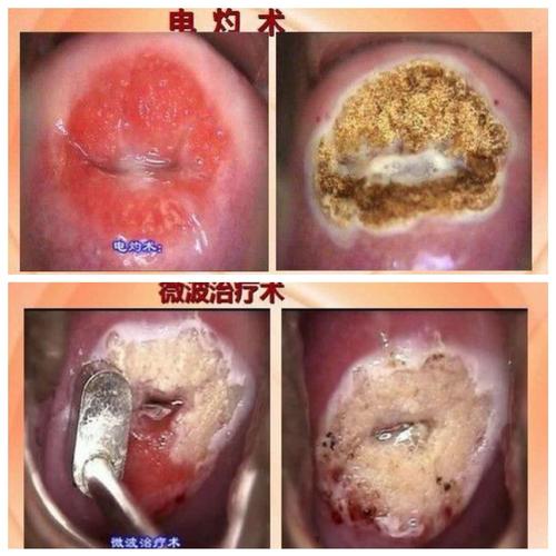 最重要的是宫颈接受三次手术后就没有了自身的免疫力,这时感染宫颈癌