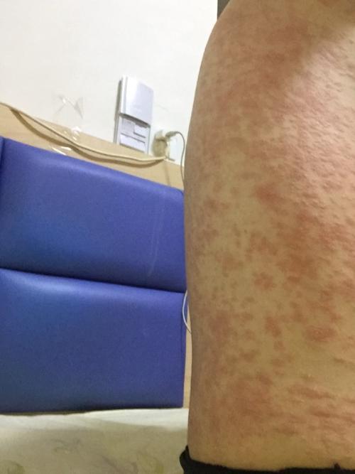 我得了玫瑰糠疹 本来只有腰上有 后来扩散到脖子 不严重 去医院