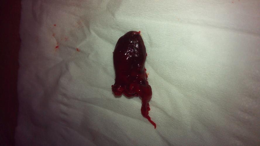 这是一个两个多月的胚胎