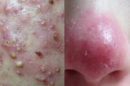 【图】怎样判断脸上有螨虫 若出现这几种状况就要小心