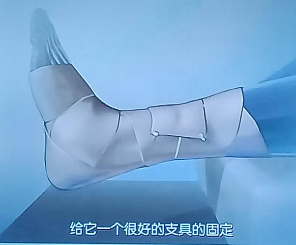 1,遵循:急性踝关节扭伤标准处理法"price"原则:保护,休息,冰敷,加压