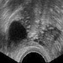 排卵期b超图详解