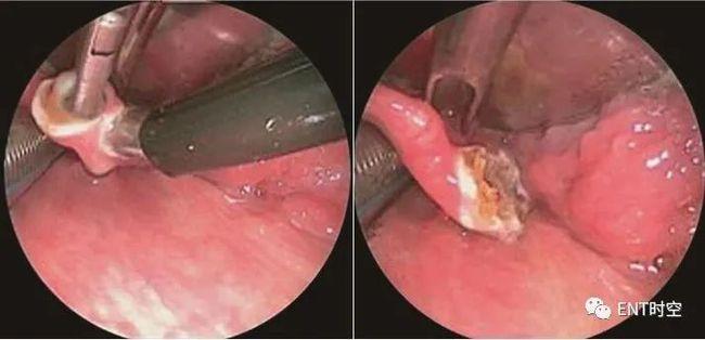 实用!鼻内镜下等离子射频会厌囊肿切除术