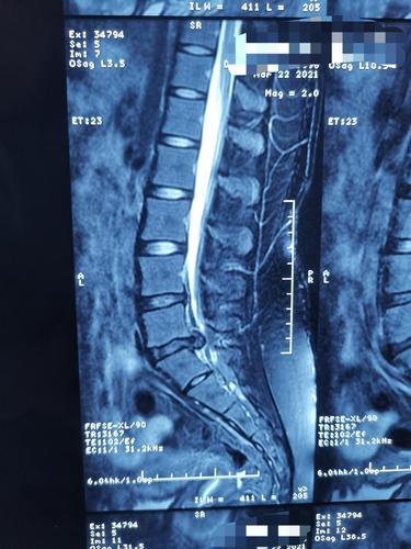 久坐开车疼得想哭,照了ct没看出问题,说是腰肌劳损