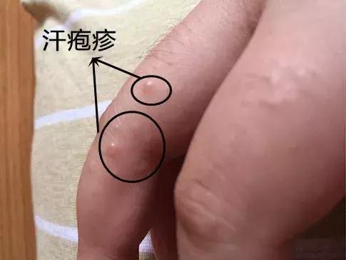 夏季汗疱疹高发,长水泡,发痒,还蜕皮?可能是身体在求救