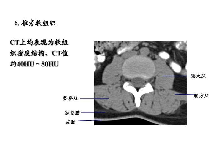 ct上均表现为软组 织密度结构,ct值 约40hu~50hu 腰大肌 竖脊肌 腰方