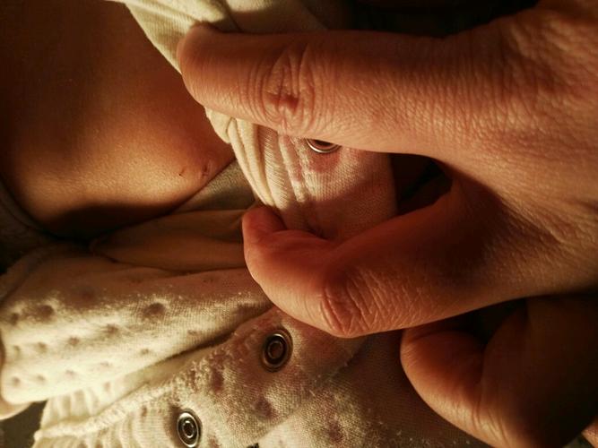 左胸下长了个小肉芽