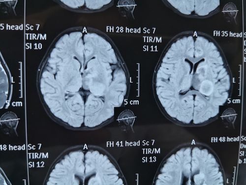 朱育霆 2岁 左侧脑室及丘脑占位 13903809976(副本)