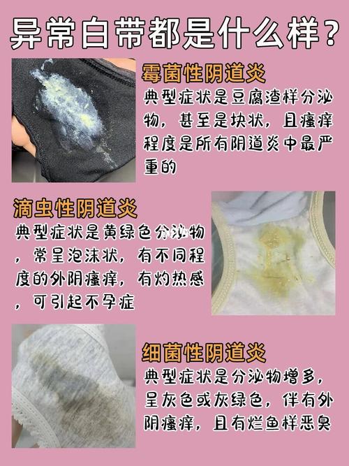 其实摆脱霉菌性阴噵炎很简单_内裤_妇科炎症_私处_洗液_男朋友_海鲜