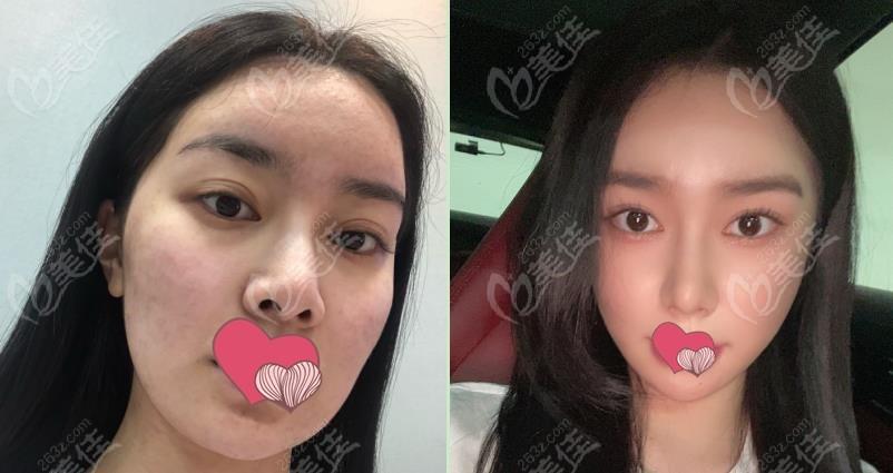 韩国1%整形做颧骨内推前后对比图