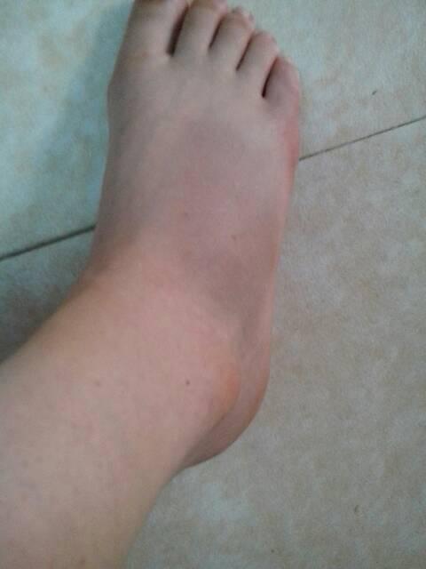 请问扭伤脚时怎么判断有没有伤到骨头