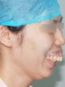 四川整形医院龅牙的悲催谁能懂?