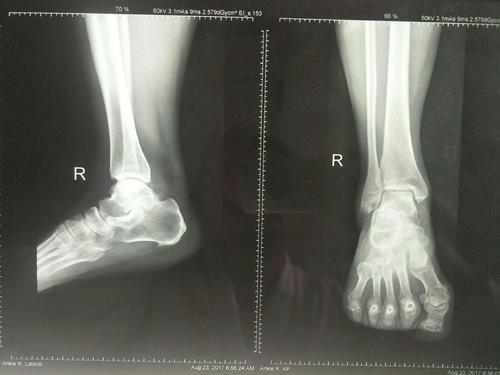 其它 踝关节骨性关节病如何治疗 写美篇 2017年8月ct平扫 2017年12月